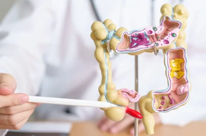 All About Diverticulitis – Symptoms, Causes, and Treatment